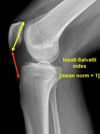 Pseudo-patella baja: giả xương bánh chè xuống thấp sau phẫu thuật thay khớp gối